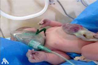 ولادة طفلة بقلب خارج القفص الصدري في بابل